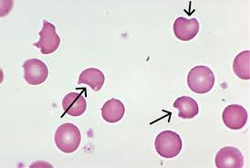 BITE CELL or (DEGMACYTE) Appears as a... - Pathology Discussion ...