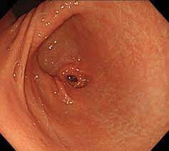 Endoscopic pyloroplasty for adult hypertrophic pyloric stenosis associated  with esophageal achalasia - VideoGIE